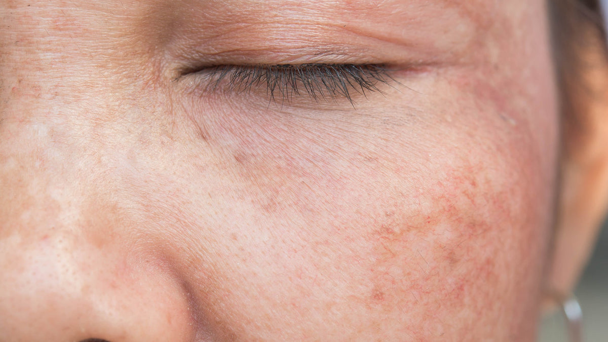 Taches pigmentaires : comment les atténuer efficacement ?