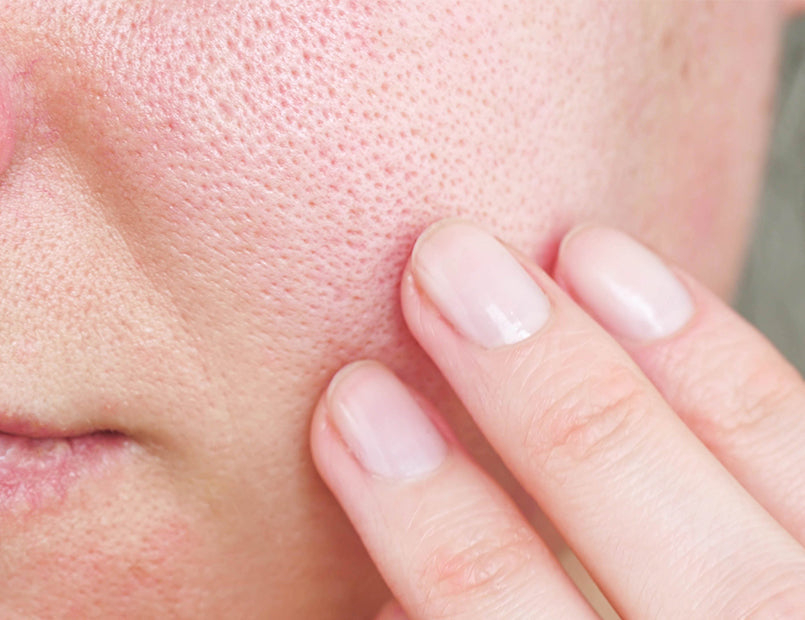 Pores dilatés : comment réduire leur apparence ?